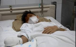 Nam sinh 15 tuổi bị cắt cụt tay vì… nghịch pháo